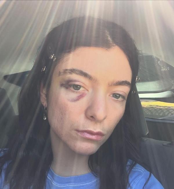 Lorde shares cryptic post with several photos of her black eye on September 30, 2024.